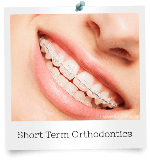 Short-term-orthodontics-services